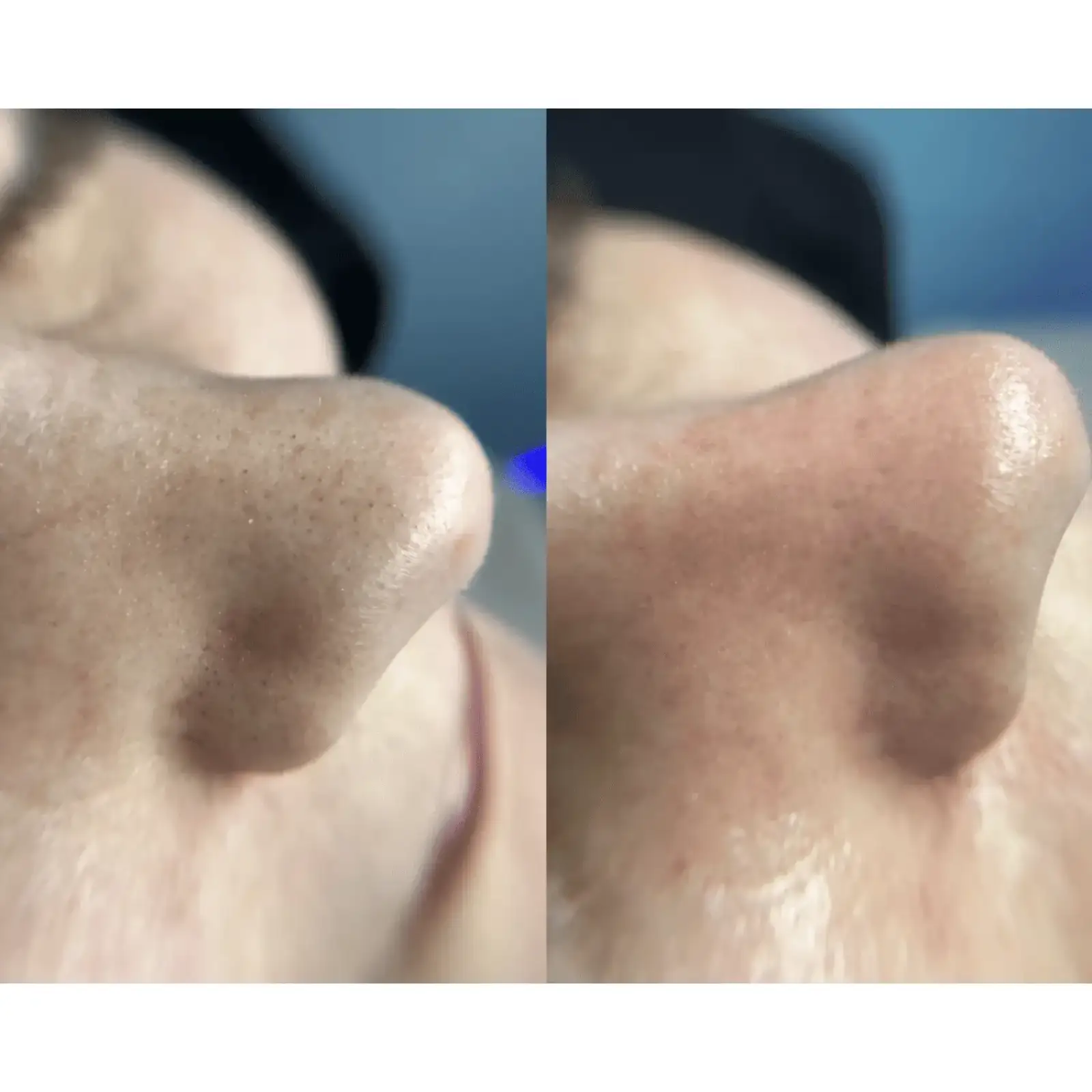 Ультразвуковий скрабер для шкіри обличчя MEDICA+ Vibroskin 8.0 UA