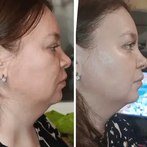 Мікрострумовий RF Lifting Масажер для обличчя Skin Lifting 7.0 Pink - EMS, LED Medica+ UA
