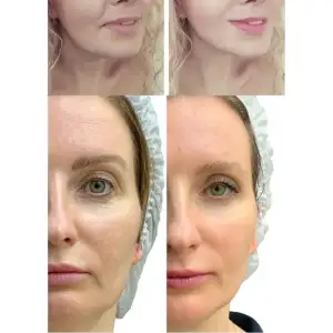 Мікрострумовий RF Lifting Масажер для обличчя Skin Lifting 7.0 Pink - EMS, LED Medica+ UA