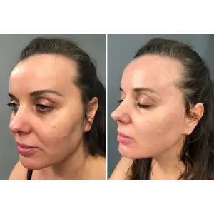 Мікрострумовий ліфтинг MEDICA+ Skin Lifting 6.0 pink UA